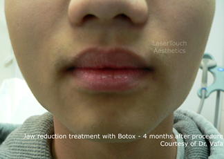 jaw reduction with Botox results midtown